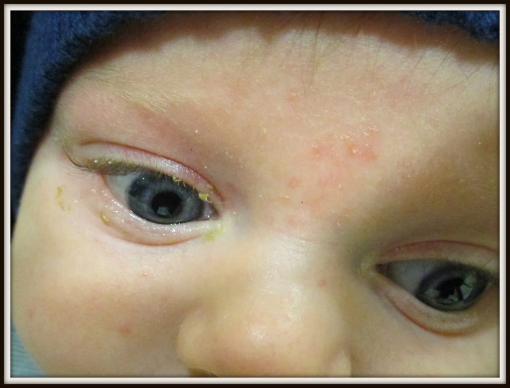 sticky eye example sticky eye example - Dentinox Eye Wipes