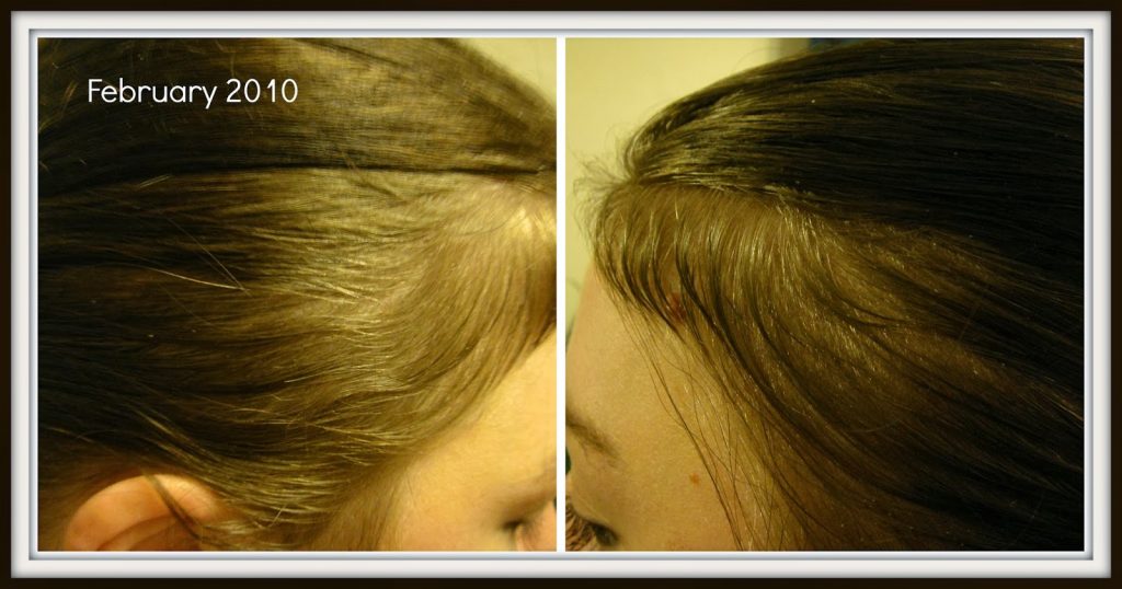 Post natal hair loss 7 months Post natal hair loss 7 months