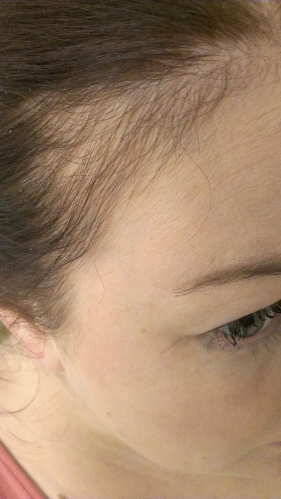 postnatal hair loss