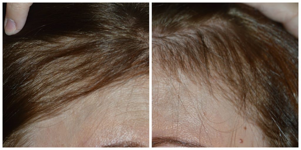 postpartum hair regrowth