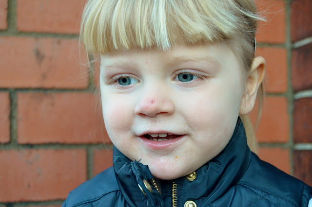 Little girl with scar on the end of her nose - treated with Germolene