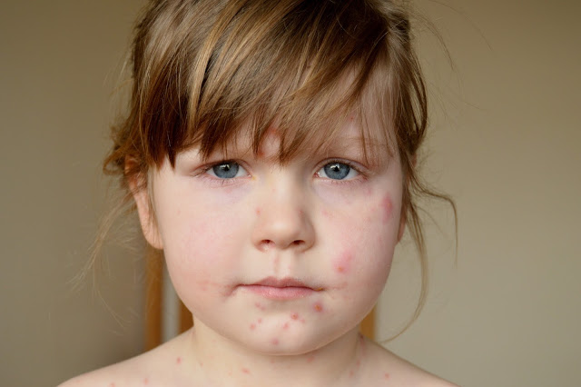 Day three of chicken pox