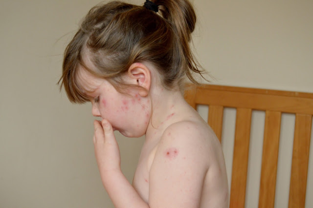 Chicken pox rash on day three