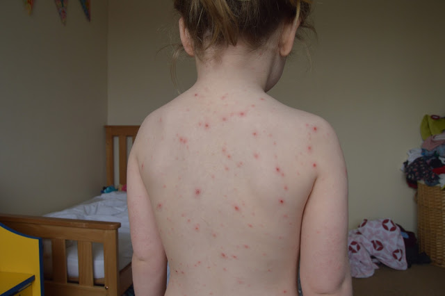 What does a chicken pox rash look like?