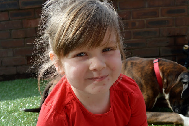 Feeling better on day 4 of having chicken pox