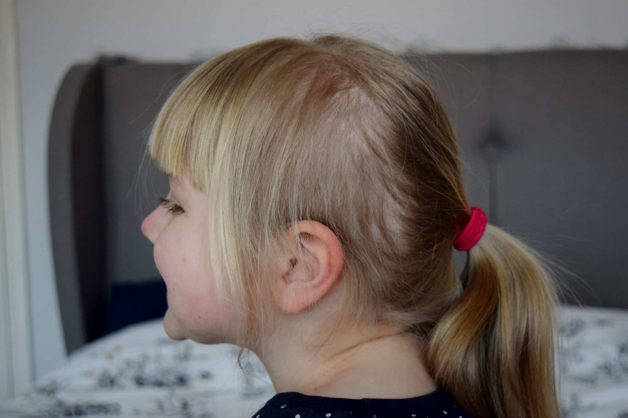 bald patch on little girl caused by hair pulling / trichotillomania