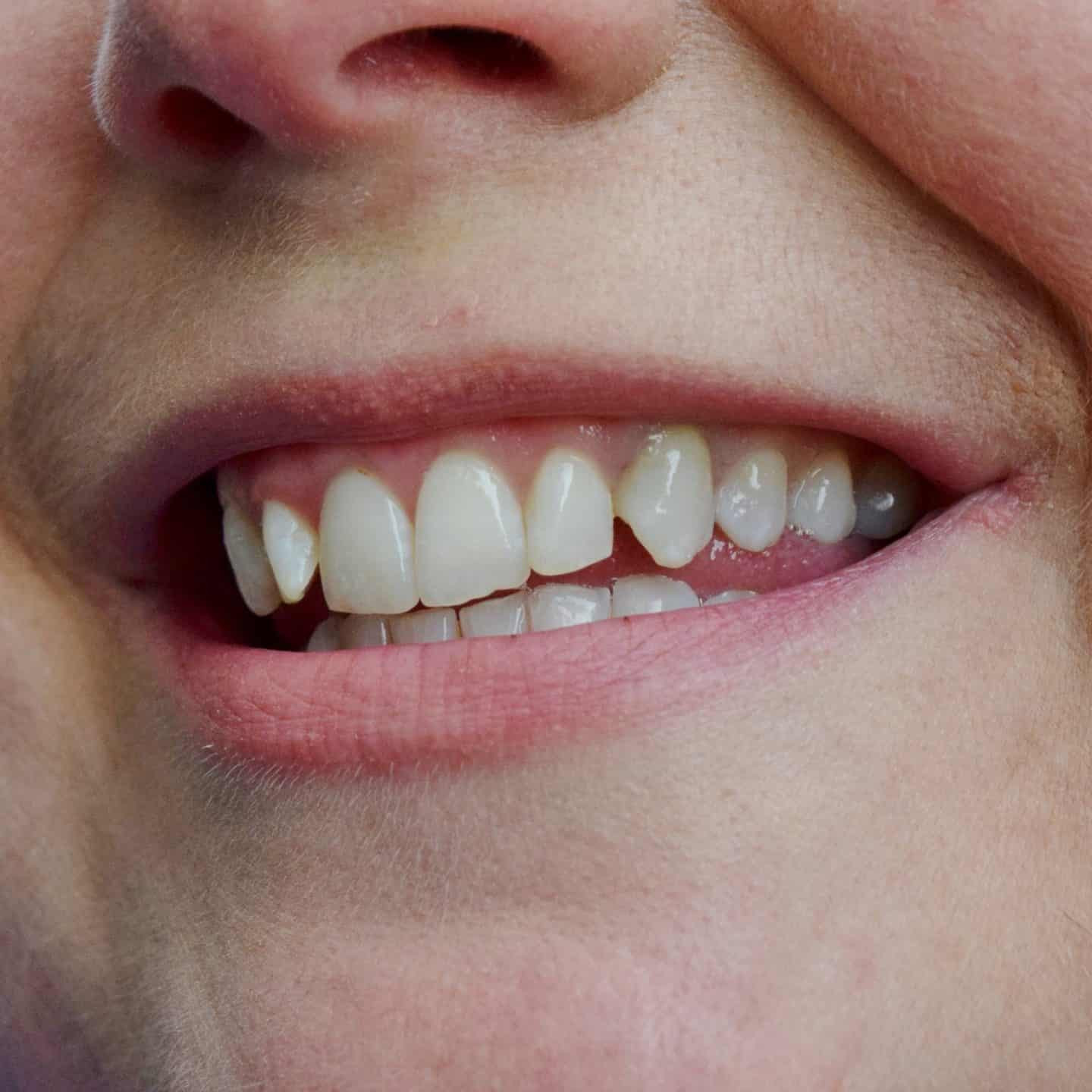 Teeth after using the Boutique whitening system