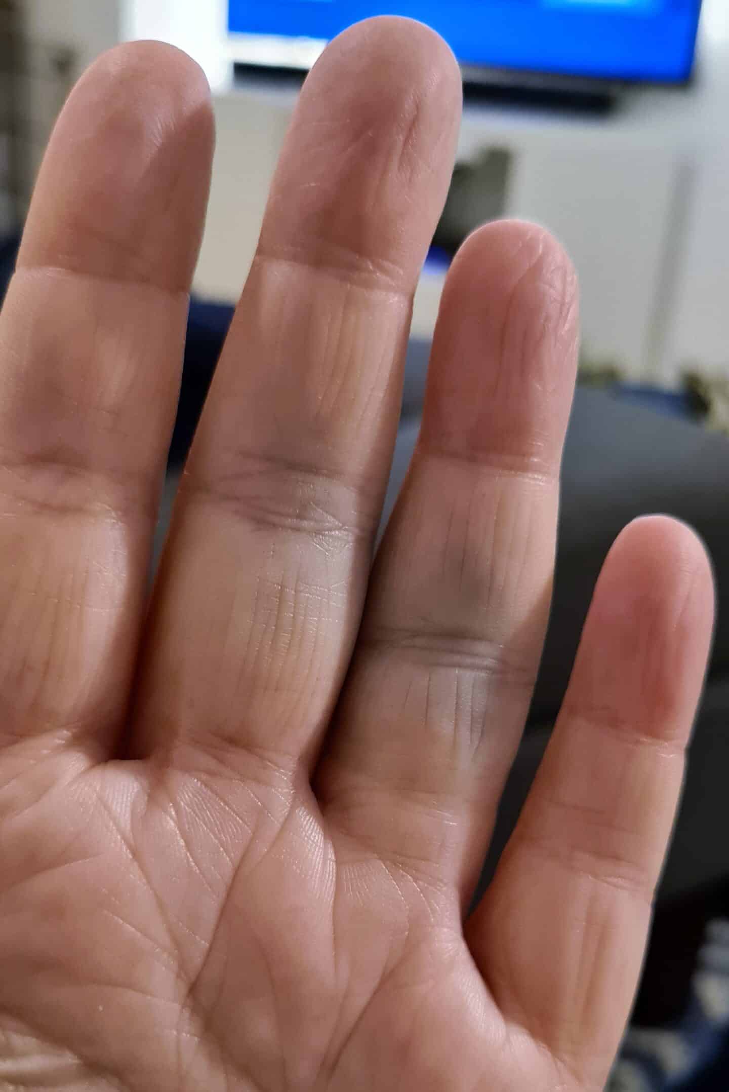 swollen and bruised fingers after falling on the ice